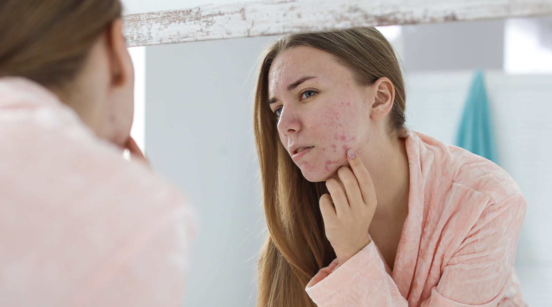 does-acne-get-worse-before-it-gets-better-how-to-know-wild-ice